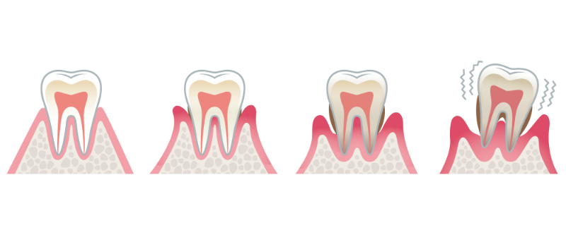 Causes for Gingivitis