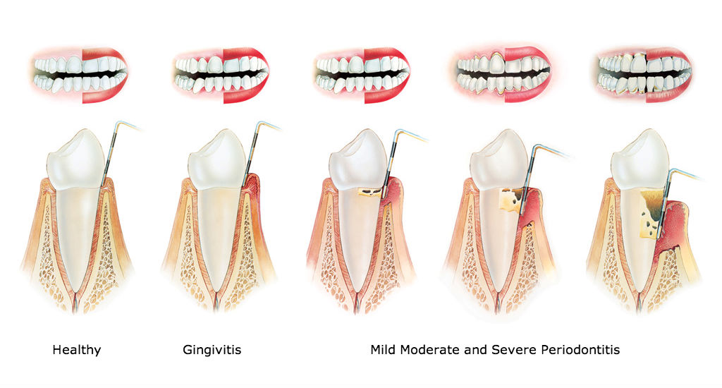 Stages of periodontitis