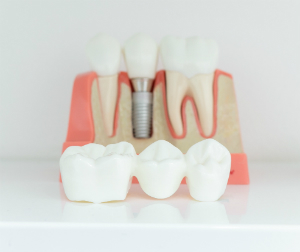 Dental Implant Model Bondi Beach