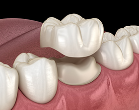 Dental Crowns Bondi