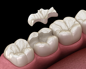 Dental Inlay Bondi