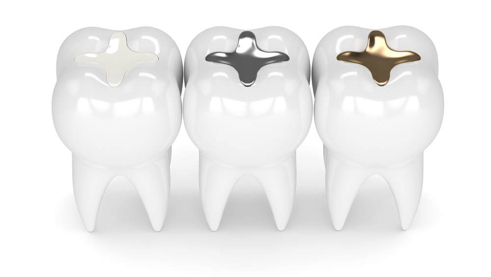 Different Dental Filling Material Bondi Clinic